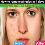 How to remove pimple in 7 days